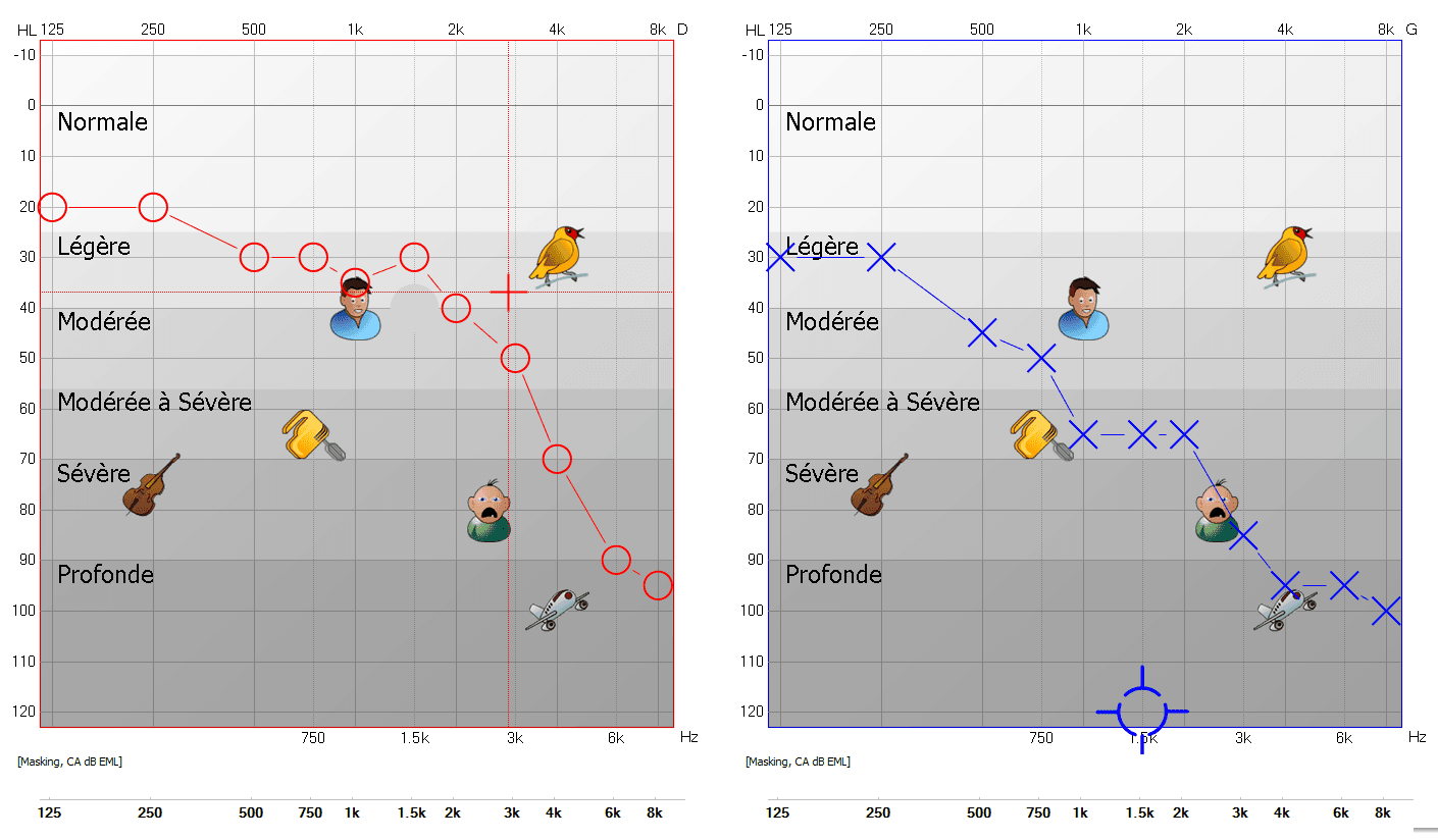 Audiogramme - Résultats du bilan auditif